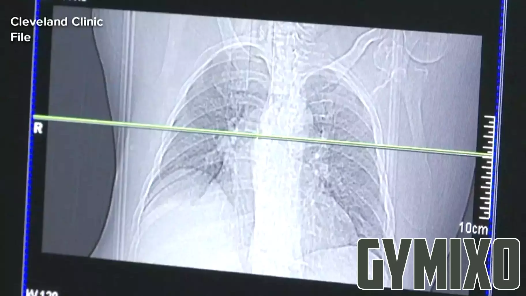 Nashua health officials search for homeless man with tuberculosis