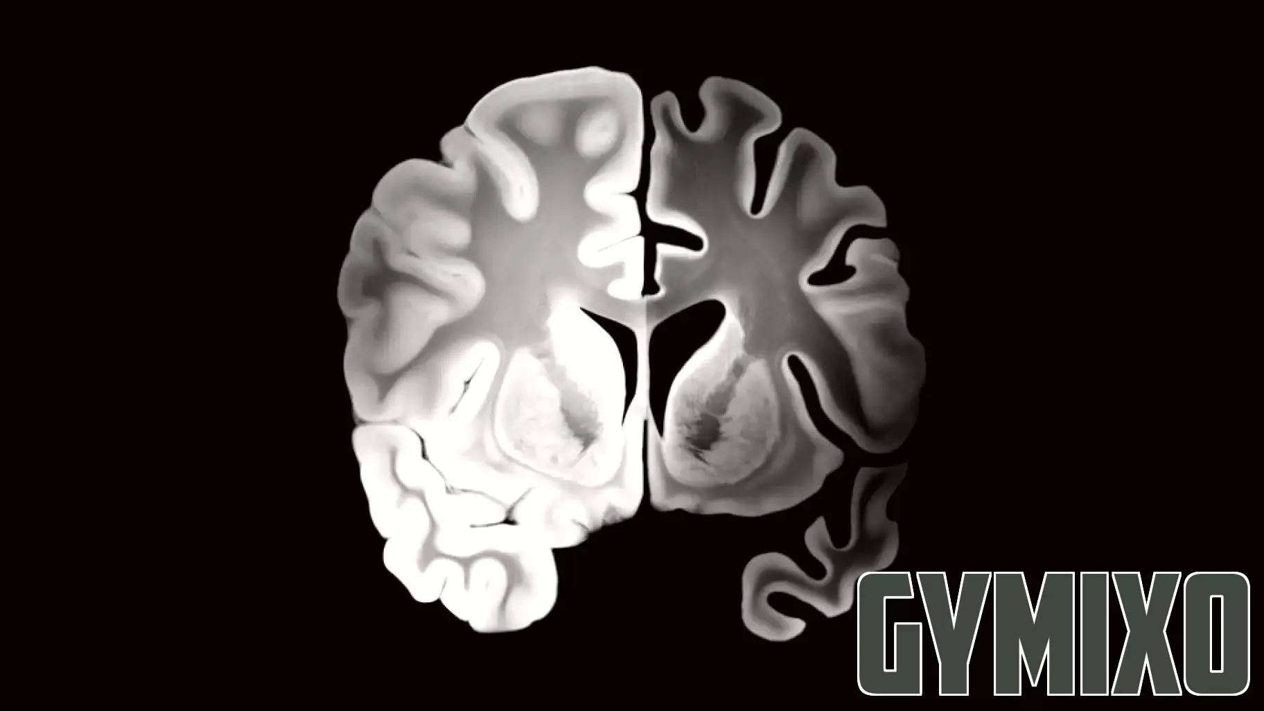 The Overlooked Crisis: Why ‘Brain Health’ Conversations Exclude Mental Illness