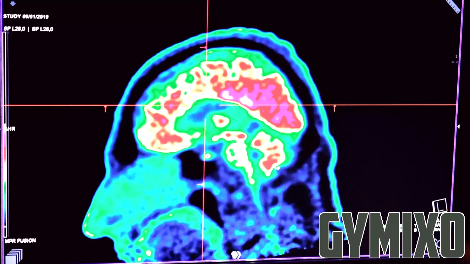 Understanding ADHD: Insights into a Common Disorder