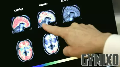 9 in 10 adults with Down syndrome develop Alzheimer’s. UNT Health research is exploring why