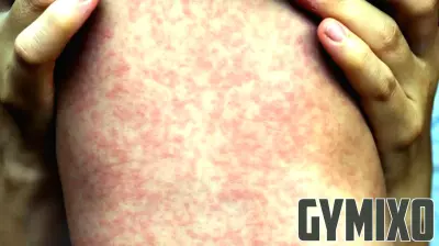 First Measles Case Reported in Grand County