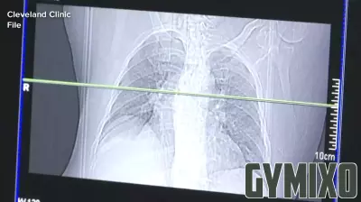 Nashua health officials search for homeless man with tuberculosis