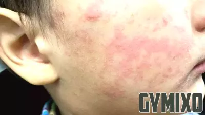 New Measles Case Identified in New Jersey Amid Nationwide Surge